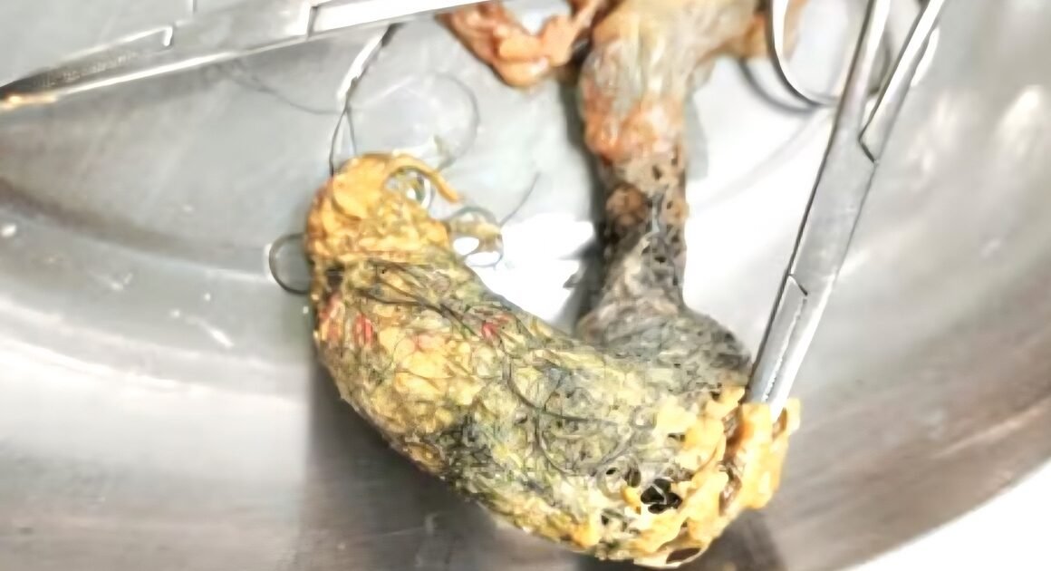 BÉ GÁI 4 TUỔI PHẢI PHẪU THUẬT LẤY BÚI TÓC KỸ LỚN HƠN 12 CM TRONG RUỘT!