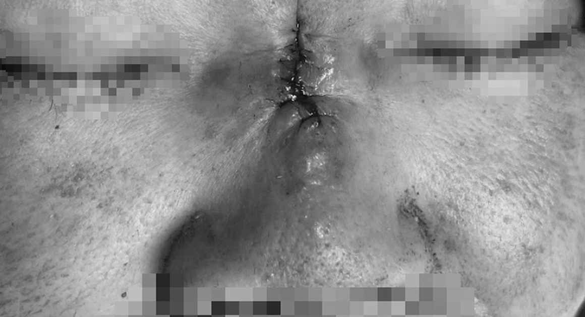 BỆNH NHÂN 43 TUỔI Ở LẠNG SƠN GẶP TÌNH HUỐNG NGHIÊM TRỌNG: MŨI HOẠI TỬ VÀ CÓ NGUY CƠ MẤT MẠNG!