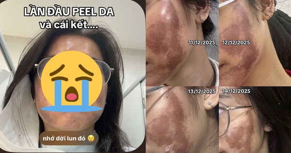 KHÔNG NGỜ ĐẾN BÀI HỌC ĐẮT GIÁ TỪ HÀNH ĐỘNG PEEL DA CỦA CÔ GÁI NÀY!