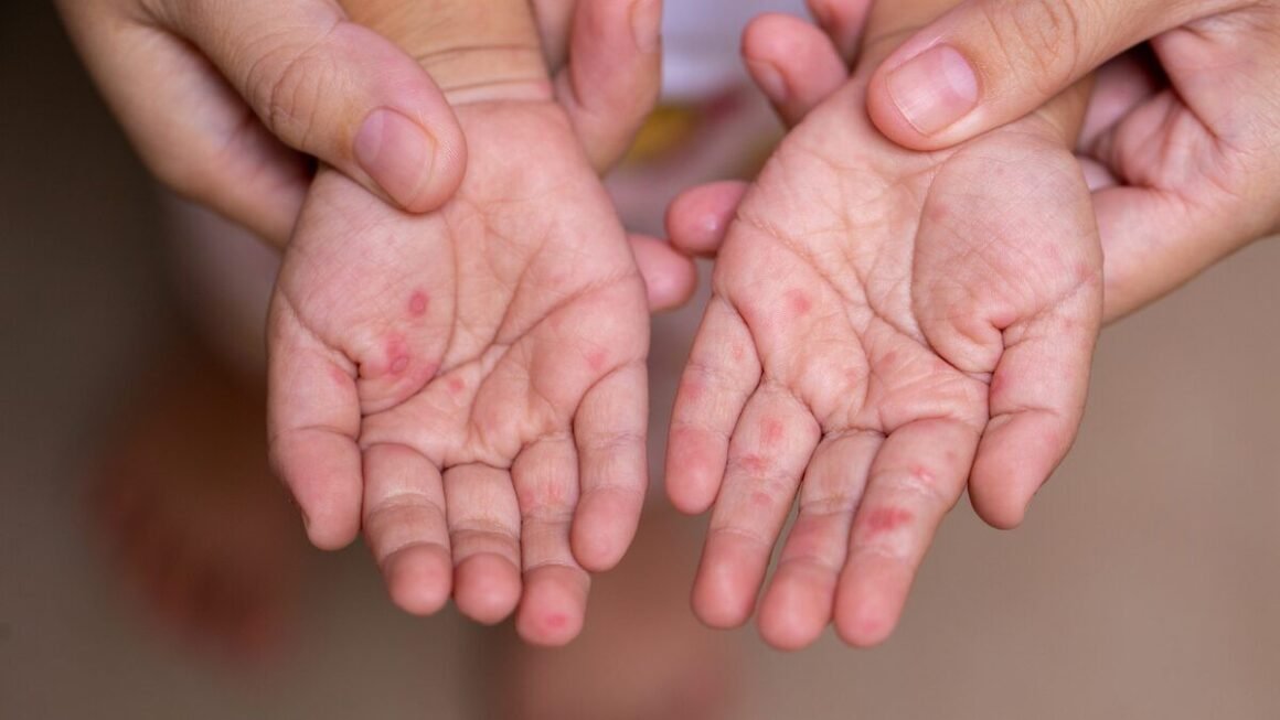 tay chân miệng bùng phát dữ dội tại tp.hcm, nguy cơ dịch bệnh lan rộng vì chủng EV71!