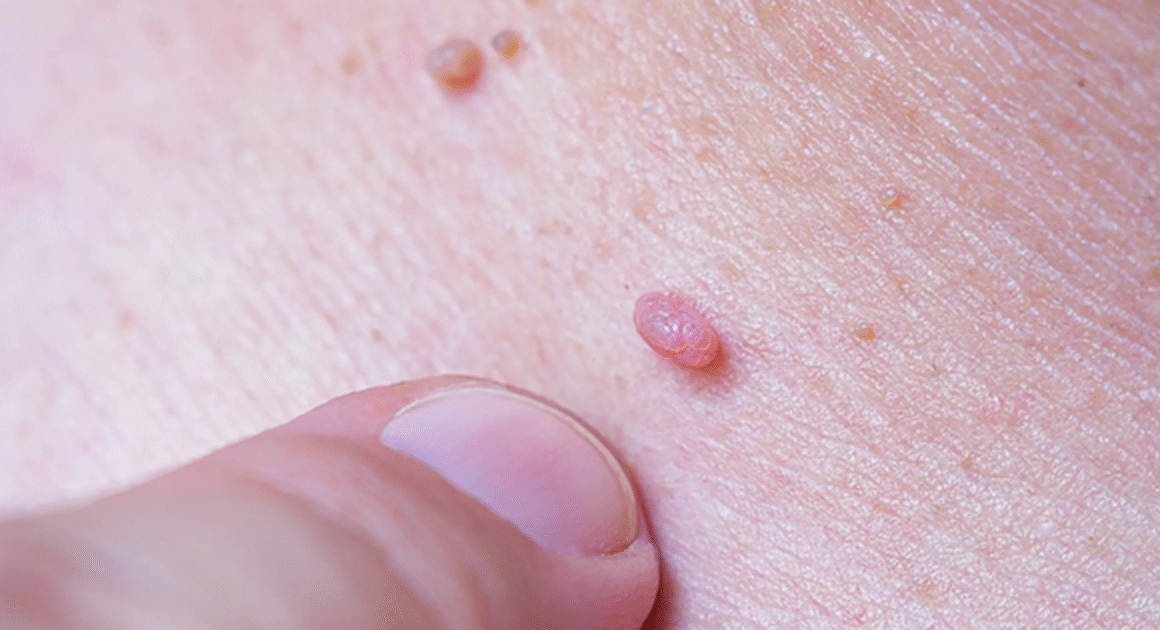 BẠN CÓ BIẾT NHỮNG ĐIỀU CẦN PHẢI KHÁM PHÁ VỀ HPV SAU KHI TỪNG CHÁY CHỨNG?