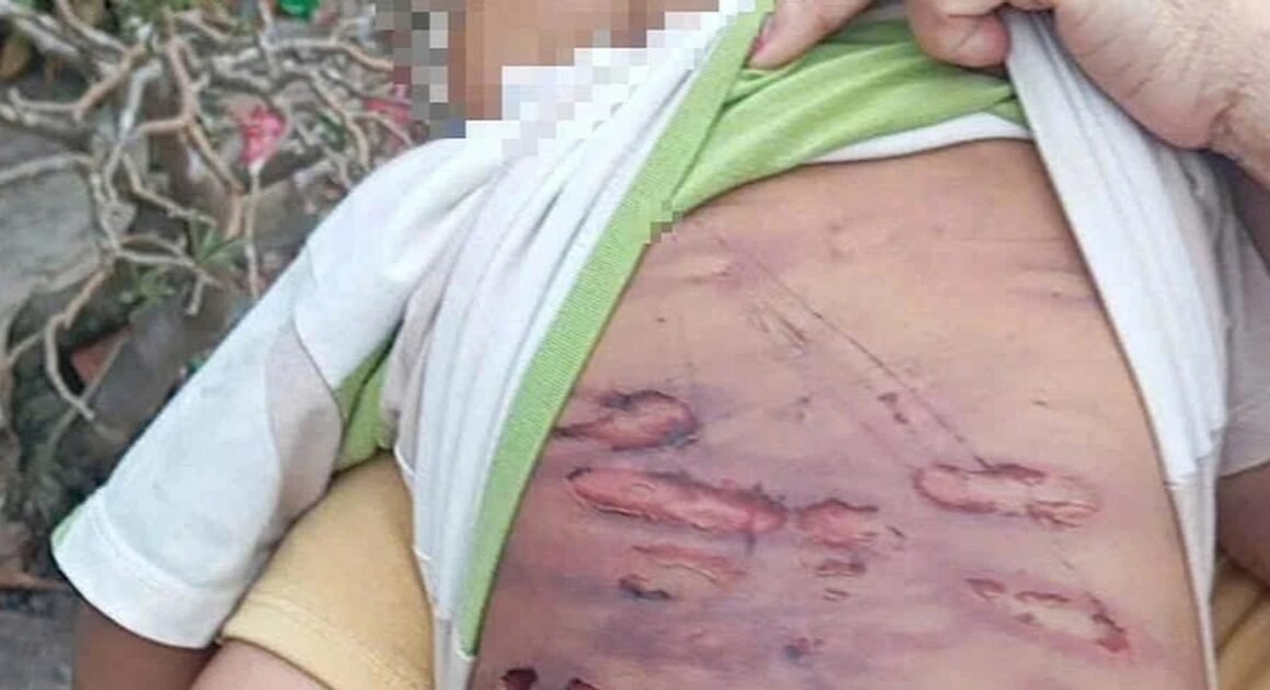 BÉ TRAI 2 TUỔI BỊ MẸ RUỘT VÀ NGƯỜI TÌNH HÀNH HẠ, GẶP NHIỀU CHẤN THƯƠNG NẶNG TRÊN CƠ THỂ!