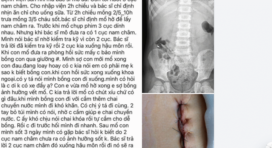 BẢN TIN SỐC: BỆNH VIỆN SẢN NHI NGHỆ AN GIẢI TRÌNH VỀ VỤ BÉ 5 TUỔI NUỐT 3 VIÊN NAM CHÂM NHƯNG CHỈ LẤY RA MỘT MẢNH!